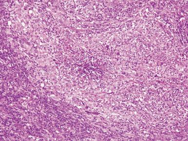 Figure 10.32, Granulomatous microabscess characteristic of granulomatosis with polyangiitis (Wegener's).