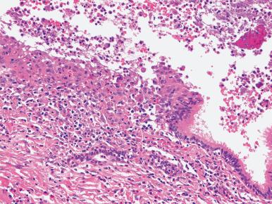 Figure 10.35, Bronchocentric granulomatosis in a patient with allergic bronchopulmonary aspergillosis. The bronchial wall is partially replaced by epithelioid histiocytes with associated eosinophilia.