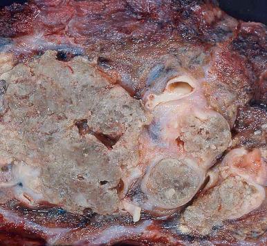 Figure 10.36, Mucoid impaction of bronchi in a patient with allergic bronchopulmonary aspergillosis. Thick, tenacious secretions expand ectatic bronchi and in this patient formed a hilar mass for which clinical concerns included carcinoma.