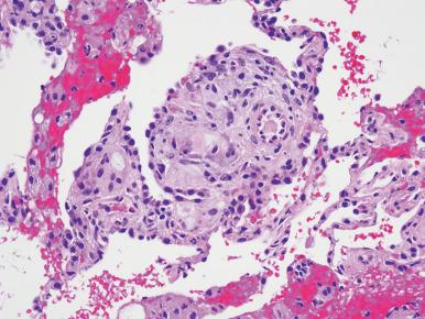 Figure 10.38, Drug abuser's lung in which perivascular granulomas include foreign body giant cells containing birefringent particulates, in this case a combination of talc and cellulose.