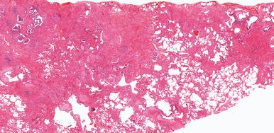 Figure 10.39, Usual interstitial pneumonia. Patchwork pattern of fibrosis with scarring and honeycomb change is characteristic.