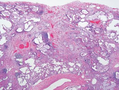 Figure 10.40, Usual interstitial pneumonia. Characteristic appearance of honeycomb change.