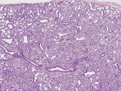 Figure 10.4, Microscopic appearance of small cyst (Stocker type 2) congenital cystic adenomatoid malformation. Microcystic air spaces lined by cuboidal epithelium are associated with tubular bronchiole-like structures lined by columnar respiratory epithelium.