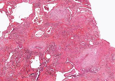 Figure 10.41, Usual interstitial pneumonia with prominent fibroblast foci. Fibroblast foci resemble organizing pneumonia except for their interstitial location.