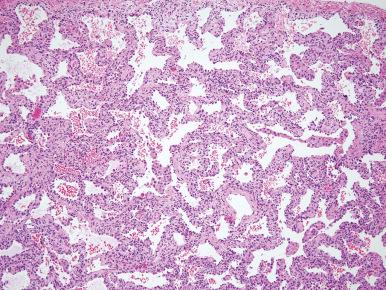 Figure 10.43, Cellular NSIP. Alveolar septa are uniformly expanded by cellular infiltrate with minimal fibrosis.