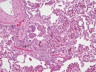 Figure 10.44, Respiratory bronchiolitis. Pigmented (smoker's) macrophages are clustered in the lumens of distal airways and peribronchiolar air spaces. The smoking-associated pigment is positive with Prussian-blue iron stains and should not be confused with hemosiderin.