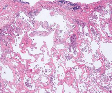 Figure 10.45, Smoking-related interstitial fibrosis. Subpleural septa are expanded by deeply eosinophilic collagen but without the patchwork distribution or honeycomb change characteristic of UIP. There is associated emphysema and respiratory bronchiolitis.