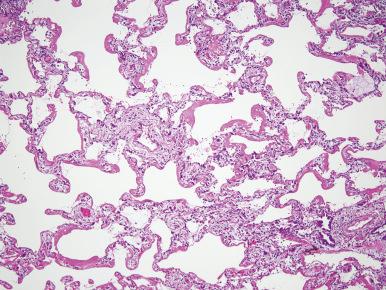 Figure 10.47, Diffuse alveolar damage in the acute phase with well-formed hyaline membranes.