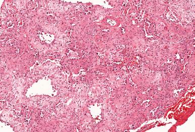 Figure 10.48, Diffuse alveolar damage in the organizing phase accompanied by alveolar collapse.