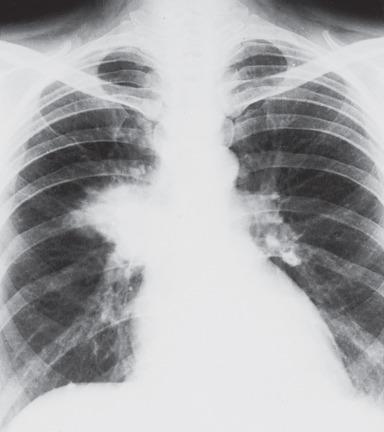 Figure 10.49, Hilar mass that was considered radiographically to be carcinoma but proved pathologically to be organized pneumonia.