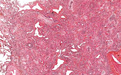 Figure 10.50, Cryptogenic organizing pneumonia showing characteristic intraluminal plugs of organizing fibroblasts and myofibroblasts. The central portion of some of the plugs show an infiltrate of chronic inflammatory cells, a nonspecific finding of no special significance.