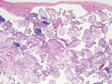 Figure 10.5, Microscopic appearance of placental transmogrification in which connective tissue papillae persist in a giant bulla resulting in an unusual histology that is reminiscent of chorionic villi.