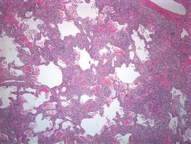 Figure 10.51, Lymphoid interstitial pneumonia in a patient with Sjögren syndrome.