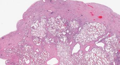 Figure 10.52, Pleuroparenchymal fibroelastosis.