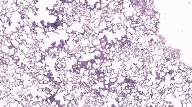 Figure 10.53, Hypersensitivity pneumonia showing patchy interstitial infiltrate of lymphocytes distributed in an exquisitely bronchiolocentric fashion.