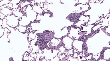 Figure 10.54, Hypersensitivity pneumonia with characteristic loose cluster of multinucleated giant cells in peribronchiolar interstitium.