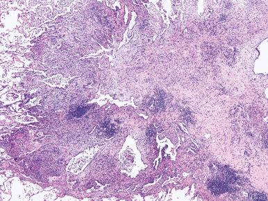 Figure 10.55, Langerhans cell histiocytosis.