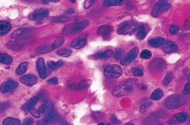 Figure 10.56, Prominent longitudinal grooves in the nuclei of Langerhans cells in a case of pulmonary Langerhans cell histiocytosis.