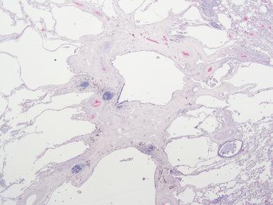 Figure 10.57, Fibrotic Langerhans cell histiocytosis showing characteristic stellate configuration and associated peripheral ‘scar emphysema’ (paracicatricial air space enlargement).