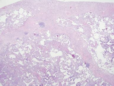 Figure 10.58, Erdheim–Chester disease.