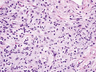 Figure 10.59, Erdheim–Chester disease involving the lung showing histiocyte-rich infiltrate.