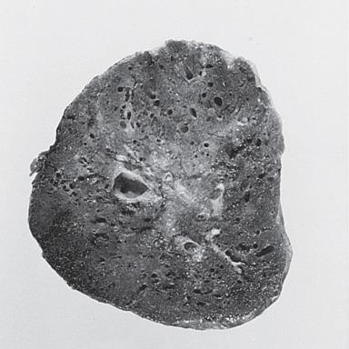 Figure 10.6, Extralobar type of pulmonary sequestration. The lung has a spongy appearance and is covered by normal pleura.