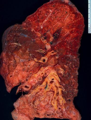 Figure 10.8, Localized bronchiectasis involving the lower lobe in a lung resected from a patient with a centrally obstructing endobronchial neoplasm.