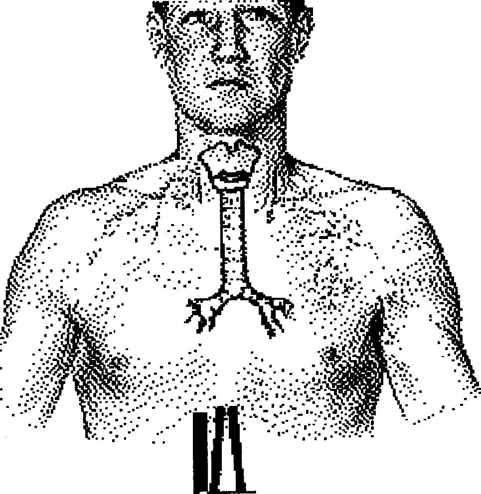 Fig. 12.5, Location and diagrammatic representation of tracheal (tubular) breath sounds.