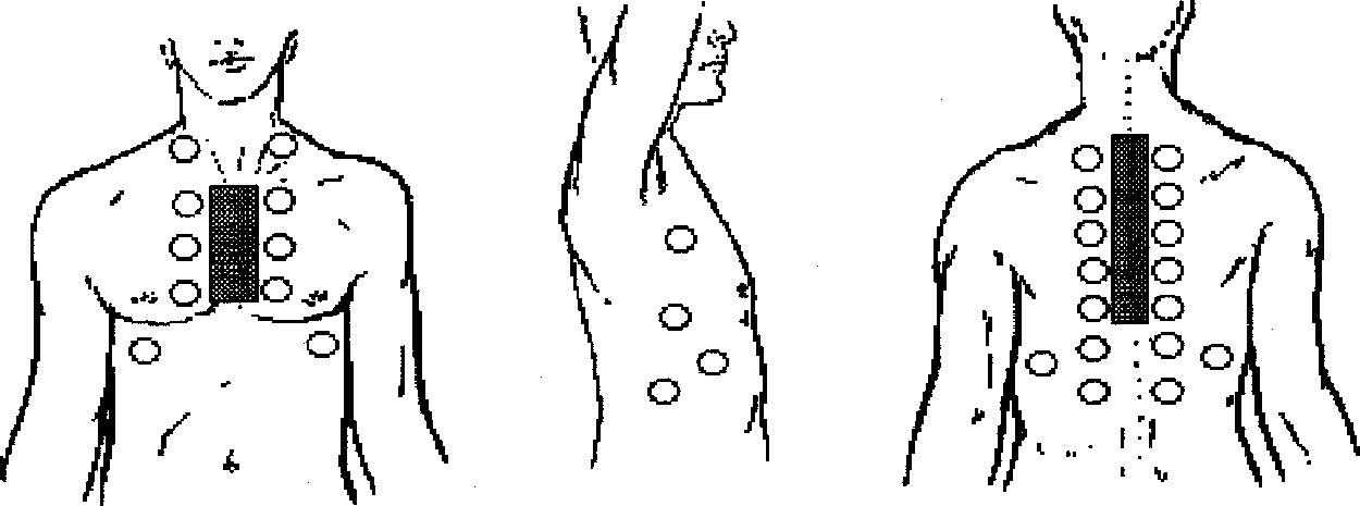 Fig. 12.7, Normal location of bronchovesicular breath sounds.