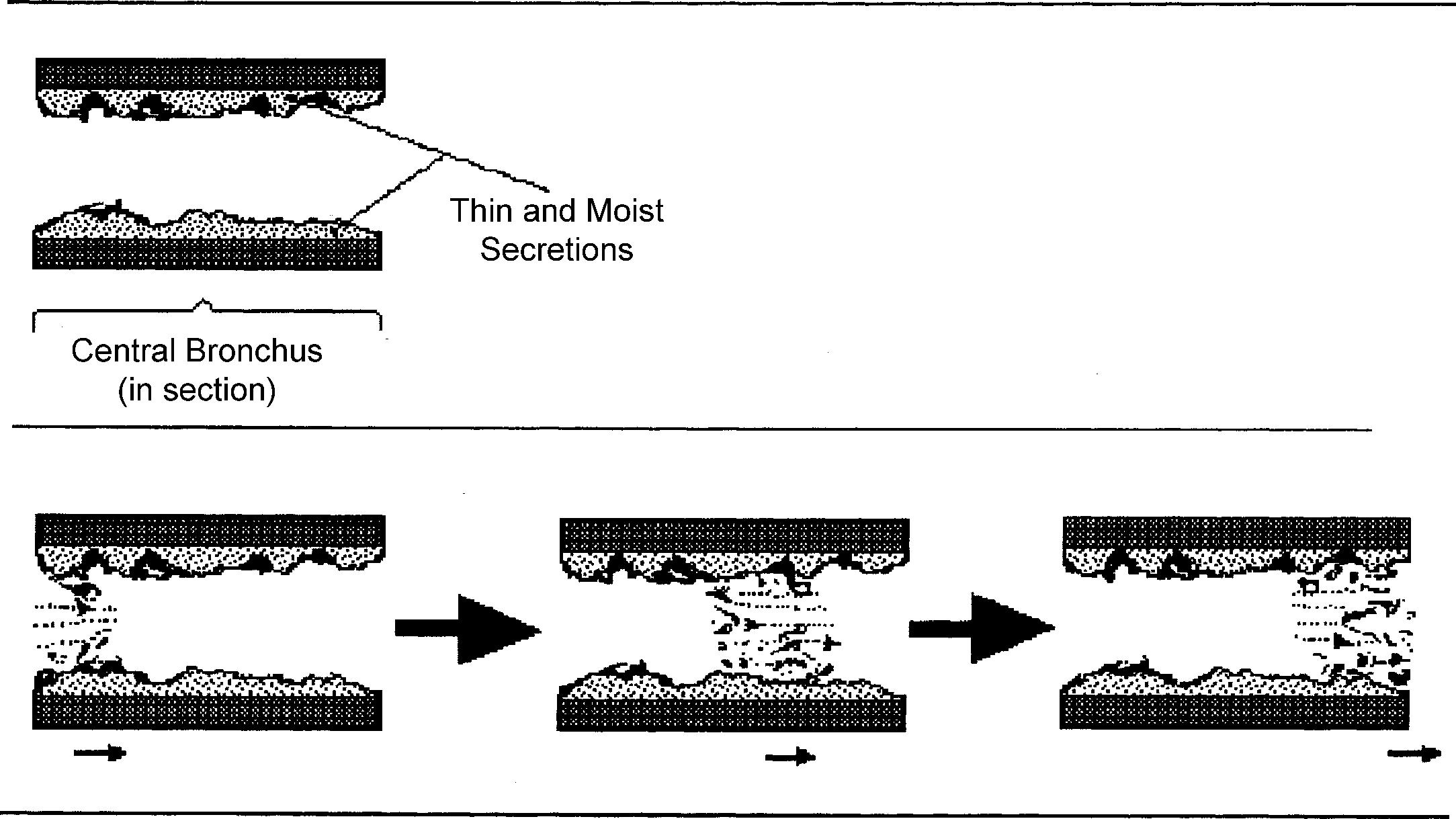 Fig. 12.8, Mechanism of production of coarse (early-inspiratory) crackles: air-fluid interface in large and central airways with rupture of fluid films or bubbles.