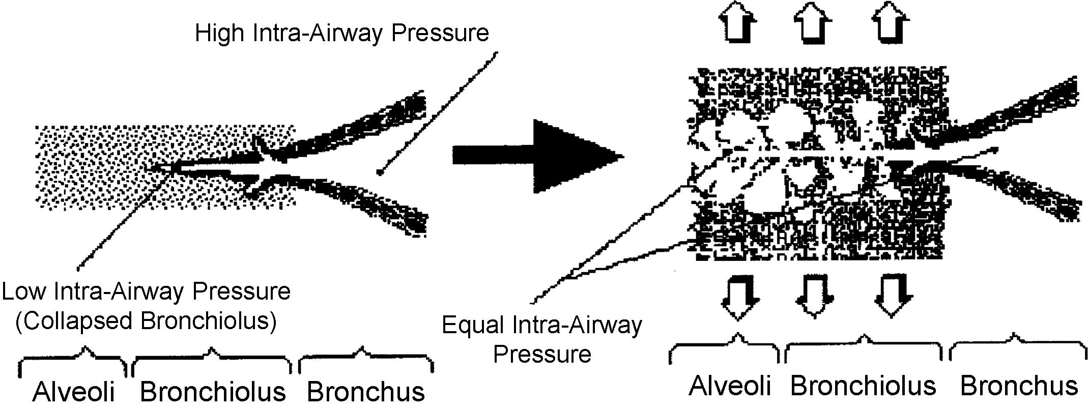 Fig. 12.9, Mechanism of production of fine (late-inspiratory) crackles: reopening of partially collapsed distant airways with sudden equilibration of intra-airway pressure.