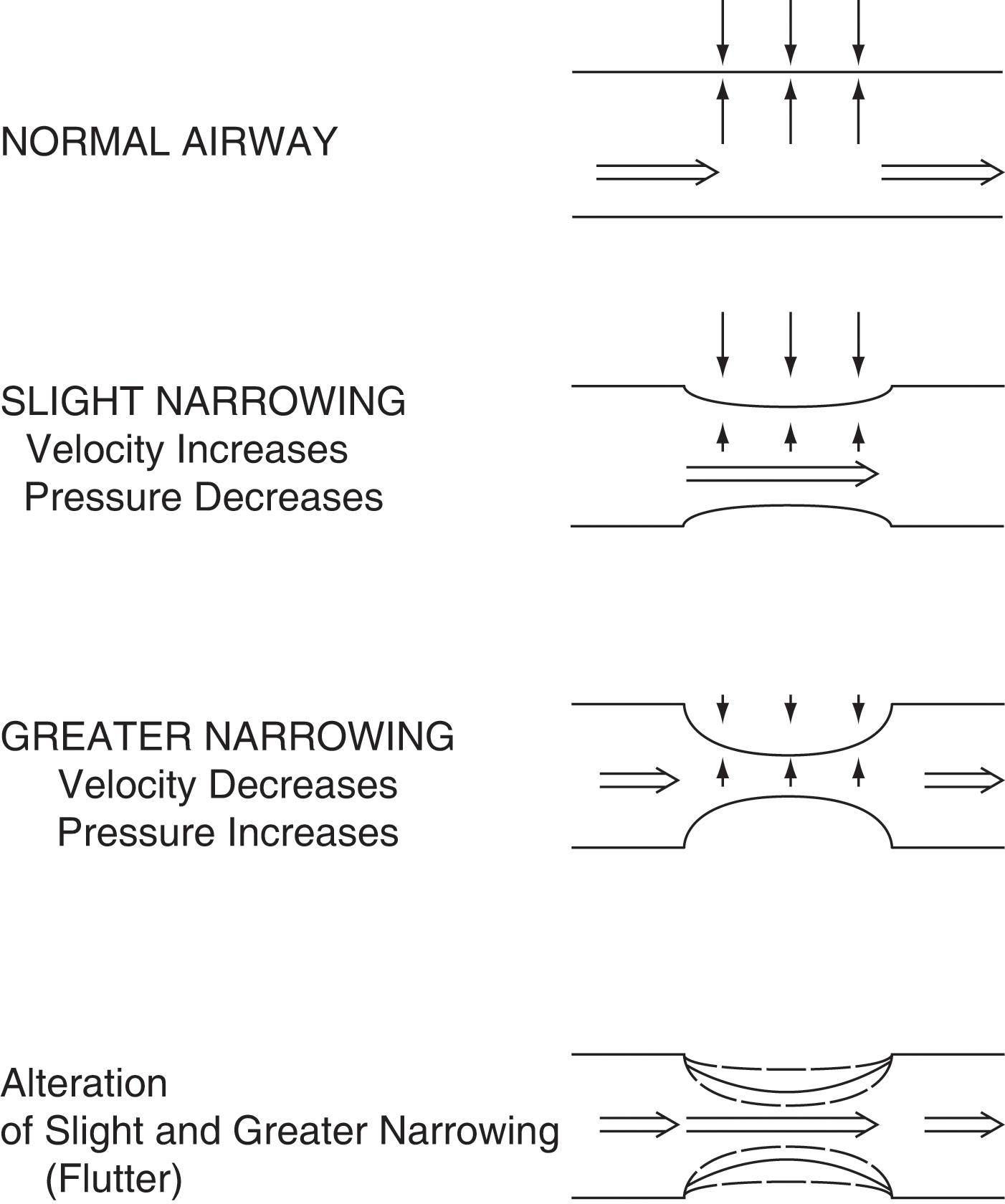 Fig. 12.10, Postulated wheeze mechanism. The stability of the airway wall depends on a balance between internal air pressure and external forces and on the mechanical characteristics of the airway itself. When a narrowing of the lumen occurs, the air velocity must increase through the constricted region to maintain a constant mass flow rate. According to the Bernoulli principle, the increased air velocity leads to a decrease in air pressure, thus allowing external forces to further collapse the airway. When the lumen has been reduced so much that the flow decreases, the process begins to reverse itself as the pressure inside the airway begins to increase and reopen the lumen. When conditions are right, the airway wall flutters between nearly occluded and occluded positions and produces wheezing. Short open arrows indicate slower flow; long open arrows indicate faster flow. Large closed arrows indicate higher pressure; small closed arrows indicate lower pressure.