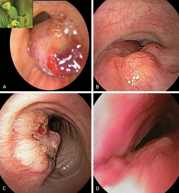 Fig. 57.1, Bronchoscopic images of four types of central airway obstruction prompting emergency intervention. (A) Exophytic lesion causing nearly total obstruction. Thermal ablation can be performed to restore airway patency. Note the external view of rigid bronchoscopy in the upper left-hand corner. (B) Nearly total tracheal obstruction by multilobulated hypervascular tumor involving the posterior membrane. Stent insertion will restore airway patency. Bronchoscopic tumor resection is not absolutely necessary. (C) Mixed obstruction (exophytic and extrinsic compression) by easily bleeding tumor involving the airway wall. Thermal ablation can be used to resect much of the intraluminal tumor. A stent will help maintain airway patency in the case of rapid tumor regrowth. (D) Nearly total airway closure from extrinsic compression by a mediastinal mass at the level of the carina and origin of the right main bronchus. Palliation is possible by airway stent insertion.