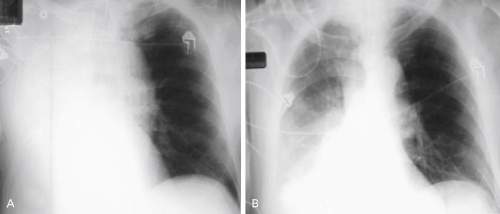 Fig. 57.2, Chest radiograph showing resolved right atelectasis after emergency intervention with flexible bronchoscopy in a patient with a known right lower-lobe tumor. In this case, respiratory insufficiency and radiographic abnormalities (ipsilateral mediastinal shift and atelectasis) were due to mucus plugging seen and removed at the time of emergent inspection bronchoscopy. (A) Shows complete collapse of the right lung. (B) After bronchoscopy.