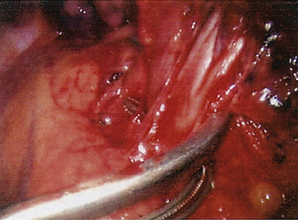 FIGURE 18-1, Left superior pulmonary vein, encircled with a curved clamp.