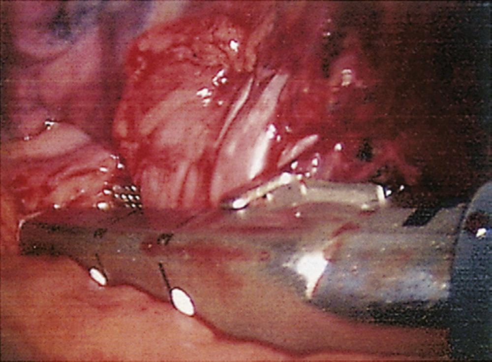 FIGURE 18-2, Left superior pulmonary vein, just prior to division with stapler.