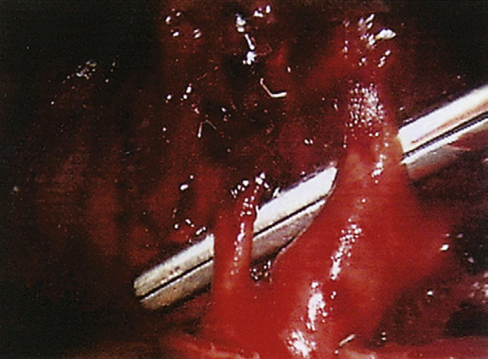 FIGURE 18-5, Posterior and lingular branches of the left pulmonary artery.