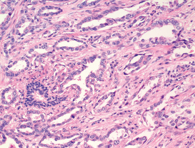 Fig. 17.1, Adenocarcinoma: pathology. Adenocarcinoma characterized by irregularly shaped glands with cytologically malignant cells exhibiting irregular hyperchromatic nuclei in a fibroblastic stroma.