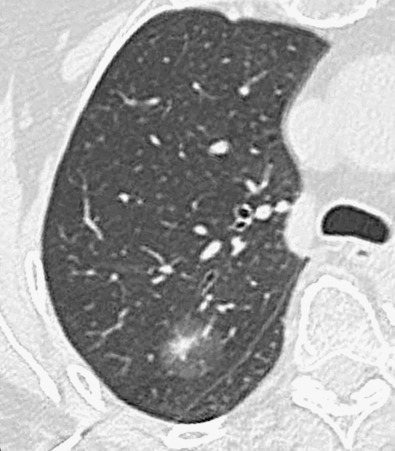 Fig. 17.11, Mixed solid/ground-glass nodule reflecting adenocarcinoma. A mixed-attenuation lesion with central solid component and peripheral ground-glass opacity is evident in the posterior segment of the right upper lobe. Biopsy specimen revealed well-differentiated adenocarcinoma.