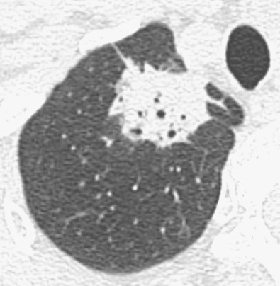 Fig. 17.12, Bubble-like lucencies in adenocarcinoma. Magnified view of right upper lobe from a high-resolution CT scan shows mass containing small round areas of low attenuation (bubble lucencies or pseudocavitation).