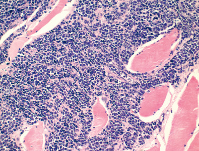 Fig. 17.3, Small cell carcinoma: pathology. Small cell carcinoma seen infiltrating skeletal muscle, characterized by cells that are densely packed, small, with scant cytoplasm, finely granular chromatin, and absence of nucleoli. Nuclear molding is readily identified; also noted are numerous mitotic figures and apoptotic cells.