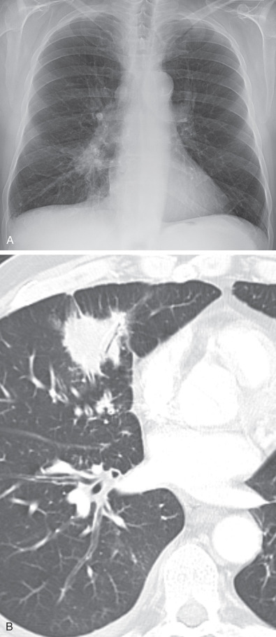 Fig. 17.4, Solitary pulmonary mass. (A) Posteroanterior radiograph shows a solitary mass with spiculated margins in the right infrahilar region. (B) Axial CT image shows a right middle lobe mass with spiculated margins and internal air bronchogram. CT-guided needle biopsy and subsequent resection showed adenocarcinoma.