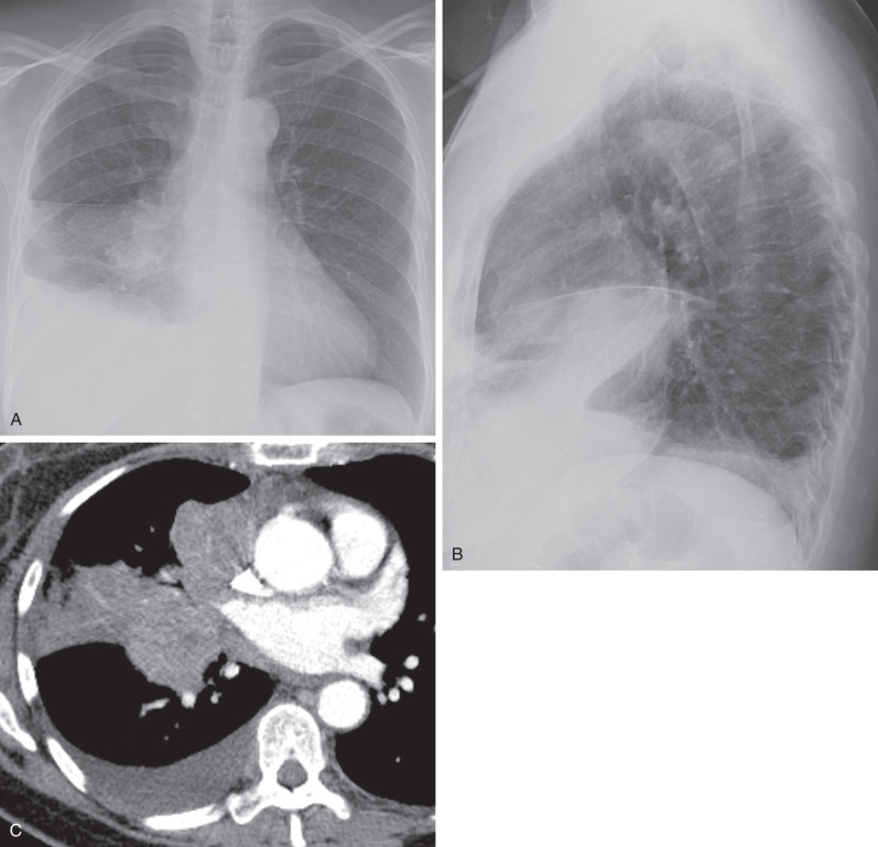 Fig. 17.5, Lobar atelectasis/opacity caused by central squamous cell carcinoma. (A) and (B) Posteroanterior and lateral radiographs show a right hilar mass and right middle lobe opacity with mild volume loss. Note the presence of a small right pleural effusion. (C) Contrast-enhanced CT scan shows a large right hilar mass invading the mediastinum and obstructing the middle lobe bronchus. A small right pleural effusion is also noted.