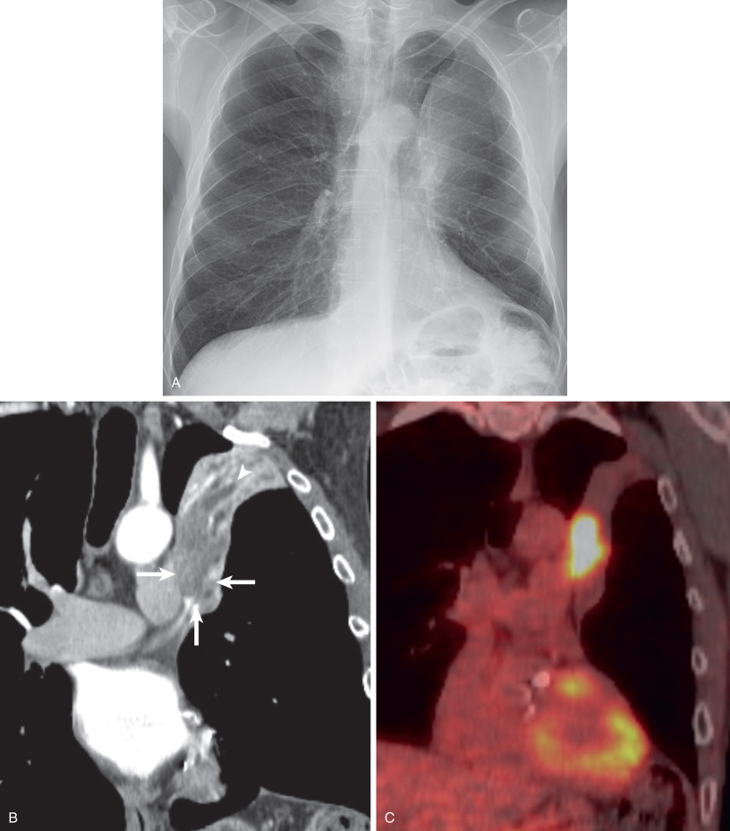 Fig. 17.6, Left upper lobe atelectasis secondary to squamous cell carcinoma. (A) Posteroanterior radiograph shows left upper lobe collapse with relative lucency adjacent to the aortic arch consistent with the Luftsichel sign. (B) Coronal reformatted CT image shows a medial left upper lobe mass (arrows) with occlusion of the left upper lobe bronchus and resultant left upper lobe atelectasis. Note the tubular low-attenuation structures (arrowhead) within the collapsed lobe because of retained secretion in the distal bronchi. (C) Fused PET-CT image shows marked fluorodeoxyglucose uptake within the mass and minimal uptake in the adjacent atelectatic lung. Bronchoscopy revealed squamous cell carcinoma.