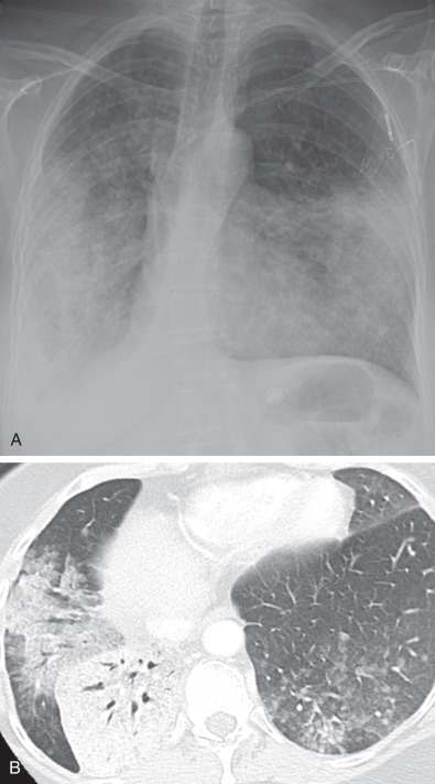 Fig. 17.7, Mucinous adenocarcinoma with multifocal opacities. (A) Posteroanterior radiograph shows bilateral patchy pulmonary opacities. (B) Axial CT image shows right lower lobe consolidation as well as bilateral ground-glass opacities.