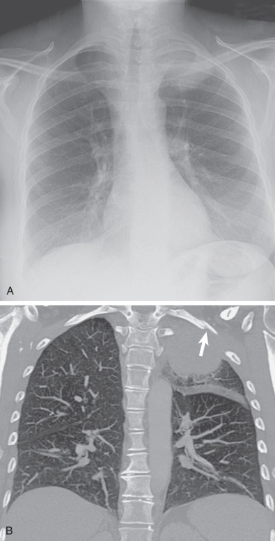 Fig. 17.8, Pancoast tumor. (A) Frontal chest radiograph shows a left apical mass. Note the convex inferior margin. (B) Coronal maximum-intensity projection reconstruction CT image shows a soft tissue mass in the left lung apex with subtle erosion of the undersurface of the left first rib (arrow). Biopsy specimen revealed non–small cell lung carcinoma.