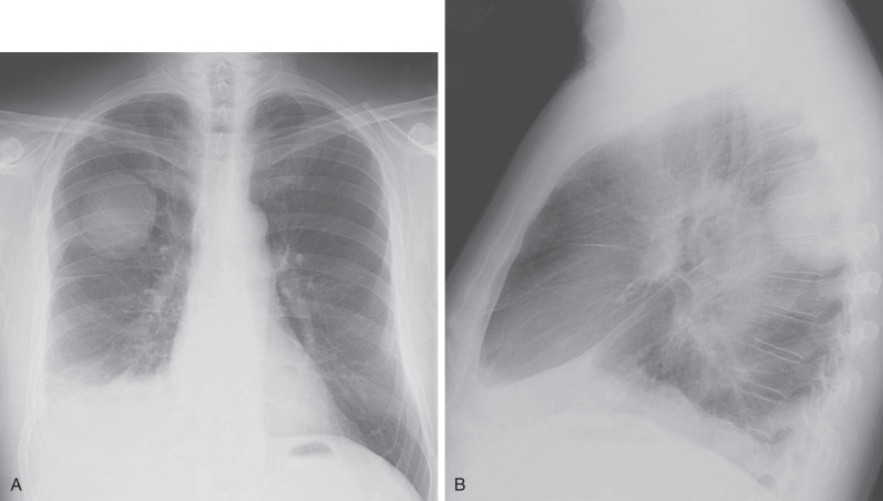 Fig. 17.9, Peripheral lung cancer with pleural invasion. Frontal (A) and lateral (B) chest radiographs show a mass in the superior segment of the right lower lobe with an associated right pleural effusion. (C) Contrast-enhanced CT image shows a soft tissue mass (arrows) in the superior segment of the right lower lobe with mixed enhancing nodules posteriorly and regions of low attenuation. Note the presence of multiloculated right pleural fluid (asterisks). (D) CT image at the level of the inferior pulmonary veins shows subtle foci of parietal pleural thickening and enhancement (arrows) within the more dependent portions of the pleural fluid. (E) Fused PET-CT image at same level as (C) shows increased metabolic activity in the right lower lobe mass (arrows). (F) Fused PET-CT image at approximately the same level as (D) shows multiple foci of increased activity along the pleura corresponding to the findings in (D). Thoracoscopic biopsy specimen revealed non–small cell lung carcinoma with pleural involvement.