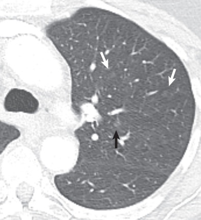 Fig. 17.10, Multifocal atypical adenomatous hyperplasia. Axial CT image shows multiple 4- to 5-mm ground-glass nodules (arrows) in the left upper lobe confirmed to represent multifocal atypical adenomatous hyperplasia in the lobectomy specimen (surgery performed for adenocarcinoma, not shown).