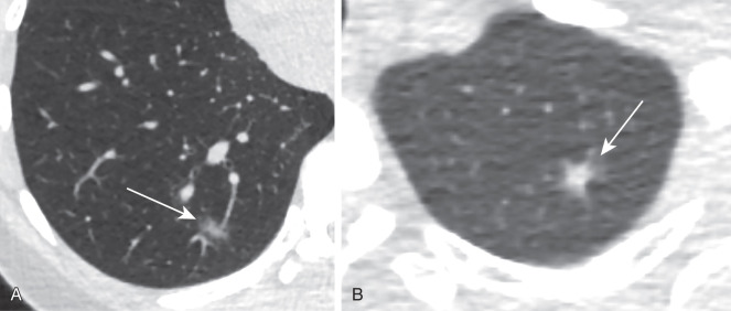 FIGURE 23.1, A 45-year-old woman who never smoked but with a strong family history of lung cancer (two generations of nonsmoking relatives). A, The dominant nodule in the right lower lobe (arrow) is a part solid nodule measuring 12 × 6 mm (mean diameter, 9 mm). B, There is a second smaller part solid nodule (arrow) in the left upper lobe. These persisted on a short-term follow-up computed tomography performed 3 months later. The patient underwent bilateral wedge resections, which found both lesions to be adenocarcinoma.