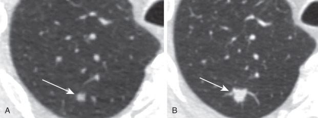 FIGURE 23.2, A 68-year-old man with a 40 pack-year history. A, The dominant nodule (arrow) on the initial screening low-dose computed tomography (LDCT) scan is a solid 5-mm nodule in the right upper lobe (category 2). B, On the next annual surveillance LDCT, the nodule (arrow) had increased in size to 11 × 9 mm (mean diameter, 10 mm) (category 4B). He underwent a right upper lobectomy, which revealed an adenocarcinoma.